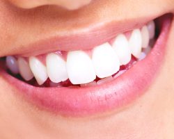 cost of professional teeth whitening