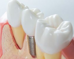 dental_implants_3